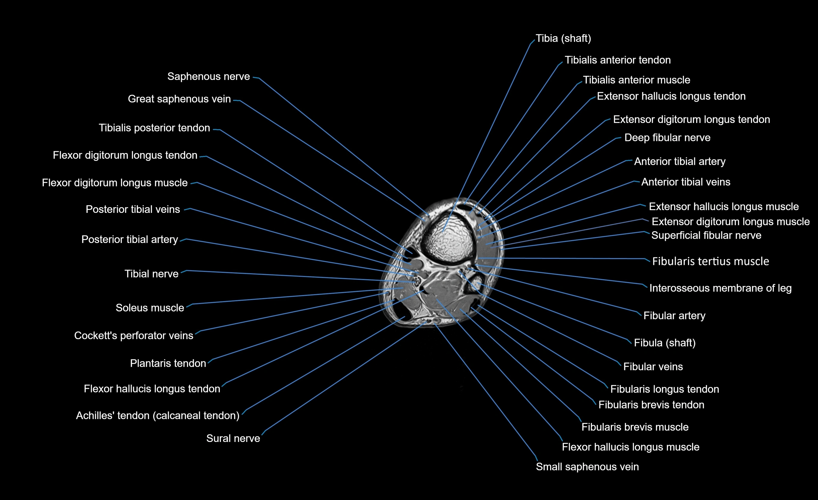 MRI lower leg axial cross sectional anatomy 3T  radiology  image-img-00001-00091.webp